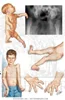 آرتروگریپوز مولتی‌پلکس کانجنیتا (AMC): Arthrogryposis Multiplex Congenita
