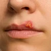 تب‌خال لب (Herpes Labialis) در بیهوشی عمومی
