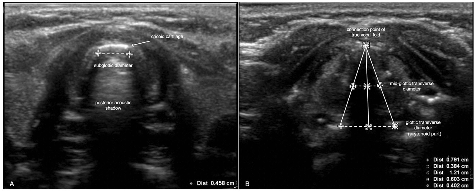 اندازه گیری سونوگرافی قطر عرضی گلوت و قطر ساب گلوت برای پیش بینی اندازه لوله داخل تراشه در کودکان: یک مطالعه کوهورت آینده نگر