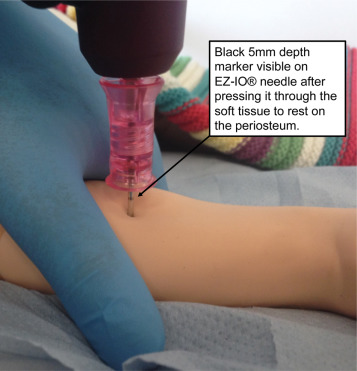 دسترسی عروقی کودکان2